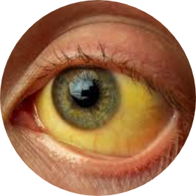 Jaundice